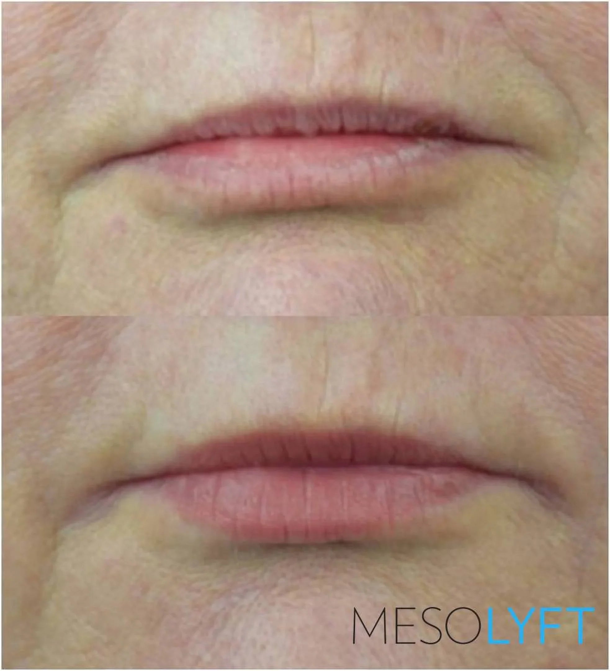 MESOLYFT - LIP Plumper