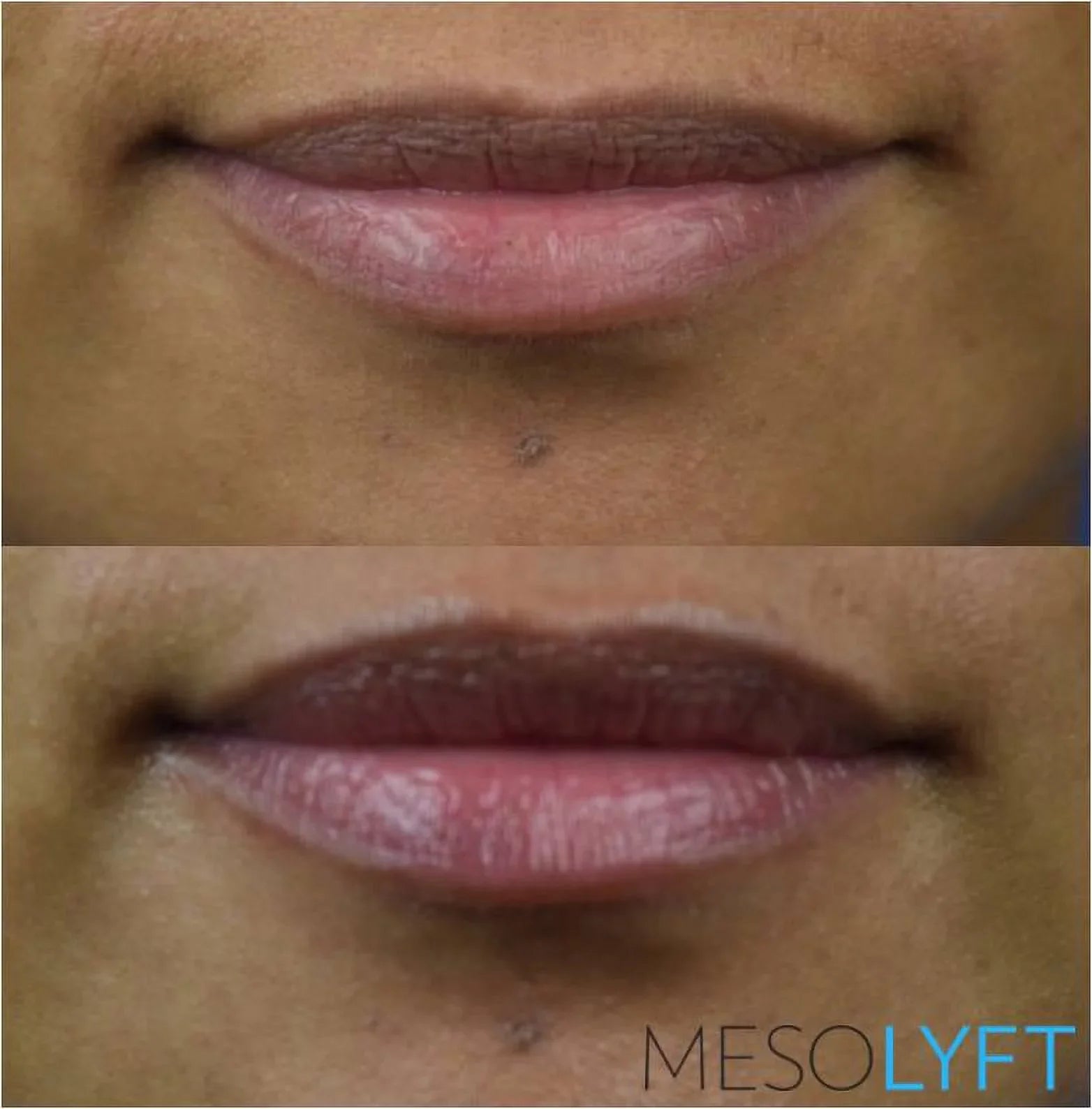 MESOLYFT - LIP Plumper